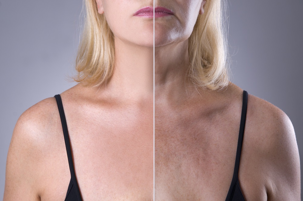 How Long Does a Neck Lift Surgery Take?