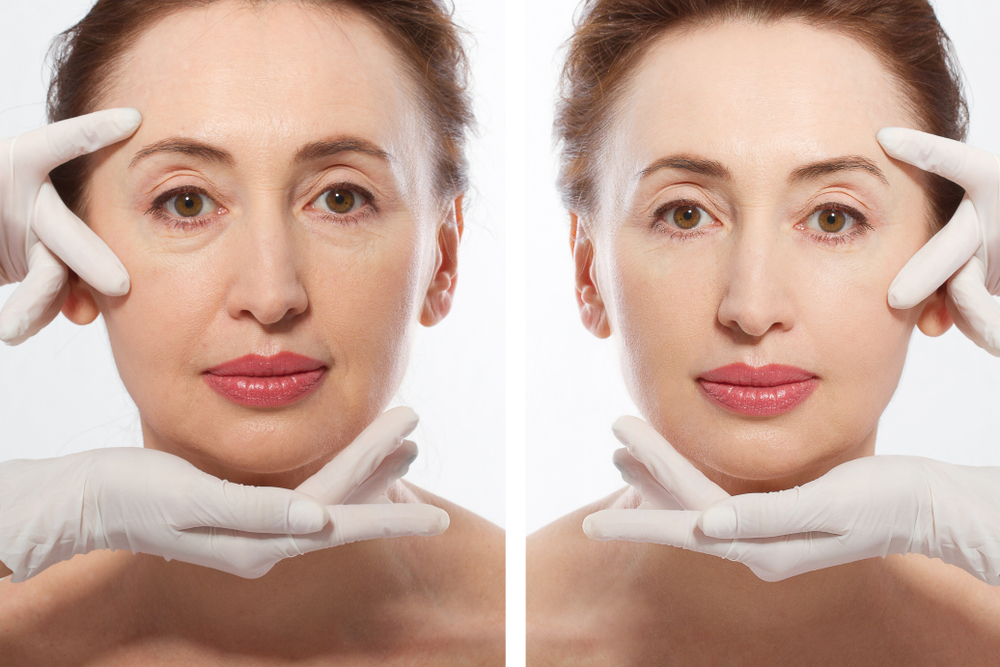 How to Get the Best Results from a Facelift