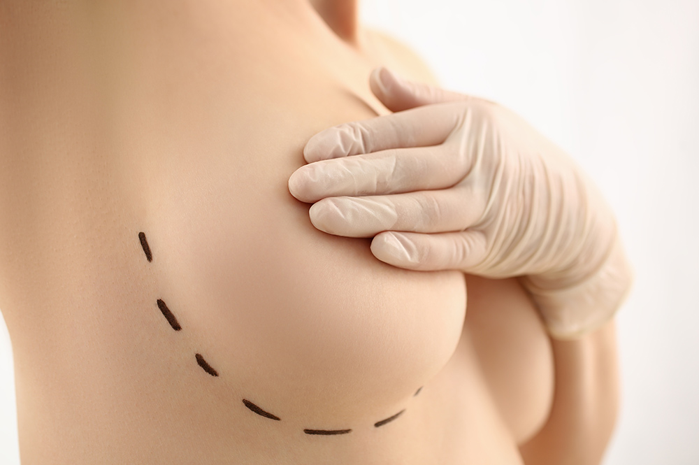 Can or Should You Have Your Breast Implants Removed?