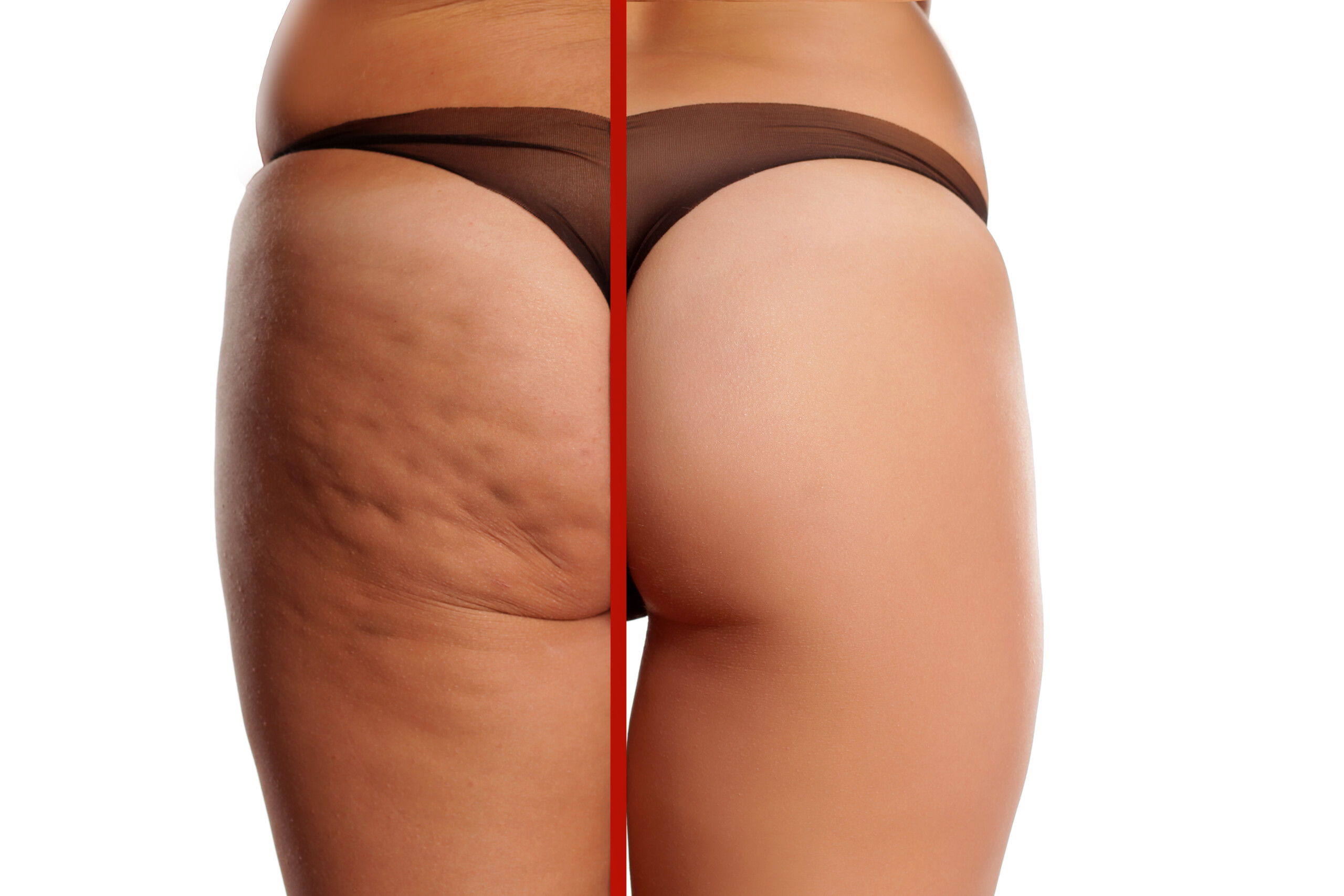 Before and after of a woman's buttocks after cellulite treatment with Aveli.