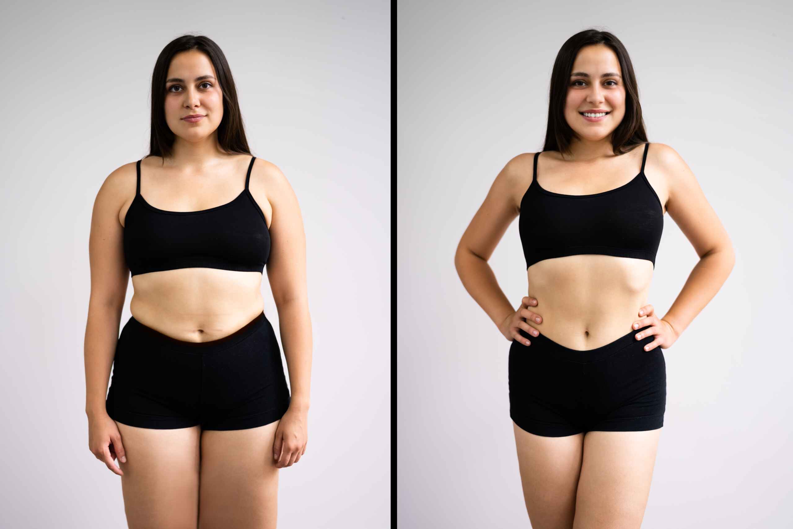 Before and After of tummy procedure. Woman is now confident.